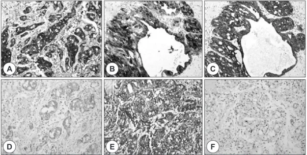 Fig. 4. The immunohistochemical findings of the right submandibular gland mass. A : The tumor cells exhibit strong  and diffuse positive staining for S-100 protein