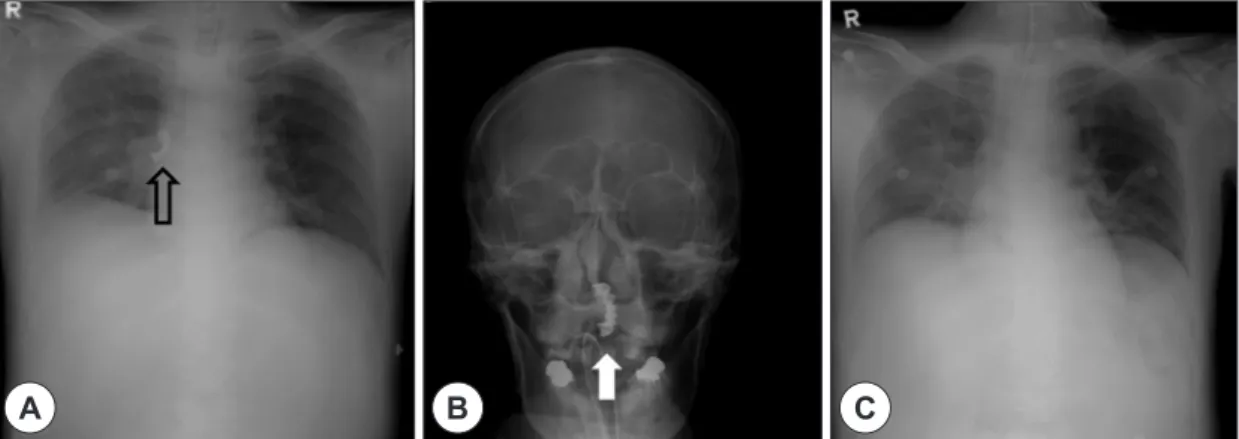 Fig. 1. Plain chest X-ray shows foreign body in right bronchus (black arrow) (A) and the lost foreign body was impact- impact-ed in the level of nasopharynx (white arrow) (B)