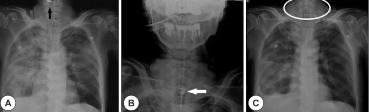 Fig. 2. Black arrow indicates the missed foreign body in upper neck level (A) and it migrated down to the upper level  of esophagus during follow up (white arrow) (B)