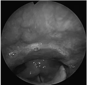 Fig. 3. Laryngoscopic view of mucus aggregation as like  band in the hypopharynx.