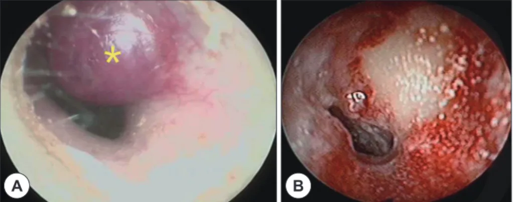 Fig. 2. A preoperative axial (A) and horizontal (B) CT view : Soft tissue density lesion (*) on Lt