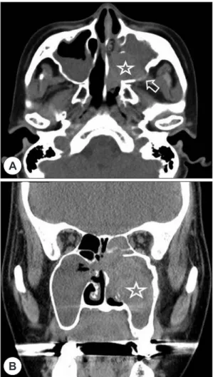 Fig. 2. A, Axial and B, coronal CT scans show a large, in- in-homogeneously enhancing soft-tissue mass in the left  maxillary sinus (asterisk)