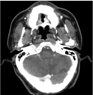 Fig. 1. Preoperative view. A well-defined mucosal mass  with central ulceration is located on the left-side hard  palate.