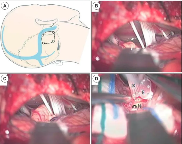Fig. 3. Surgical field of auditory brainstem implantation (ABI, Right side). XI : 11st cranial nerve, hypoglossal nerve, E :  electrode, N : cochlear nucleus.