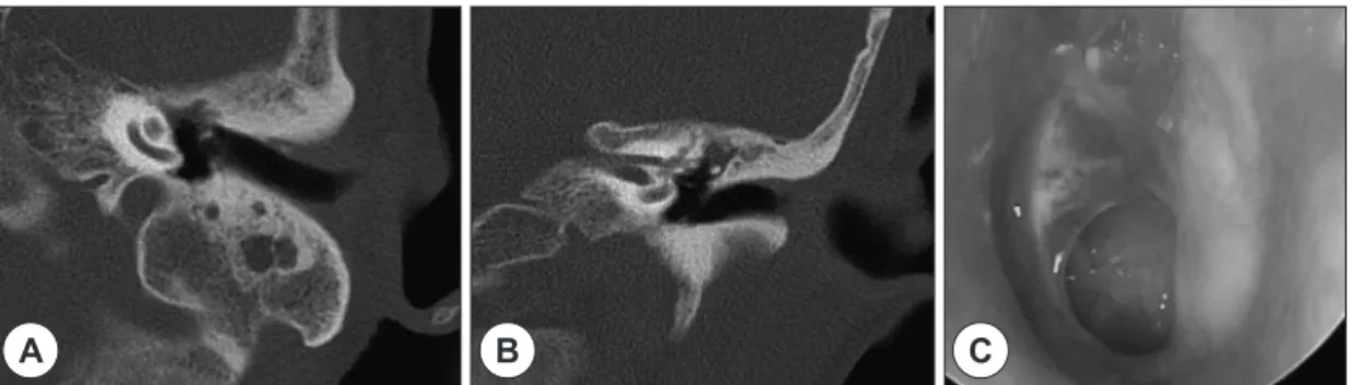 Fig. 5. Follow-up temporal bone CT scan (A and B) and ear drum finding (C) at 3 months post-presentation