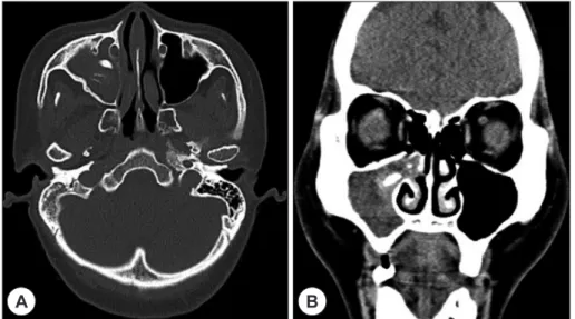 Fig. 1. Preoperative axial (A) and coronal (B) computed tomography scans. CT scans show soft tissue density lesion in  the right maxillary sinus with slight bulging contour at the right uncinate process and high density oval shaped lesion  about 1.5 cm wit