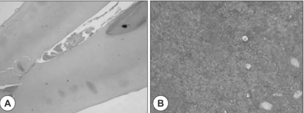 Fig. 3. A : Histopathology specimen of the calcified mass shows enamel-like structure, clinically it seems like ectopic  tooth (H-E stain ×40)