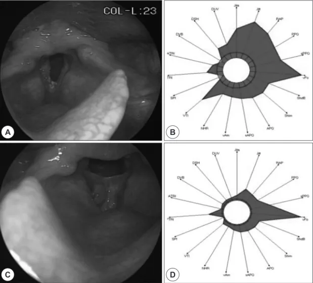 Fig. 1. Laryngoscopic findings and acoustic analysis before and after surgery. At the first visit to the outpatient de- de-partment, the laryngoscopic finding shows tumor with irregular surface (A) with distortion of voice quality shown on  acoustic analys