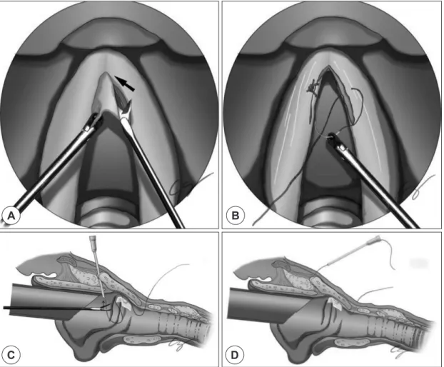 Fig. 2. Operative procedures. The glottic web of anterior commissure was dissected using microscissors (A)
