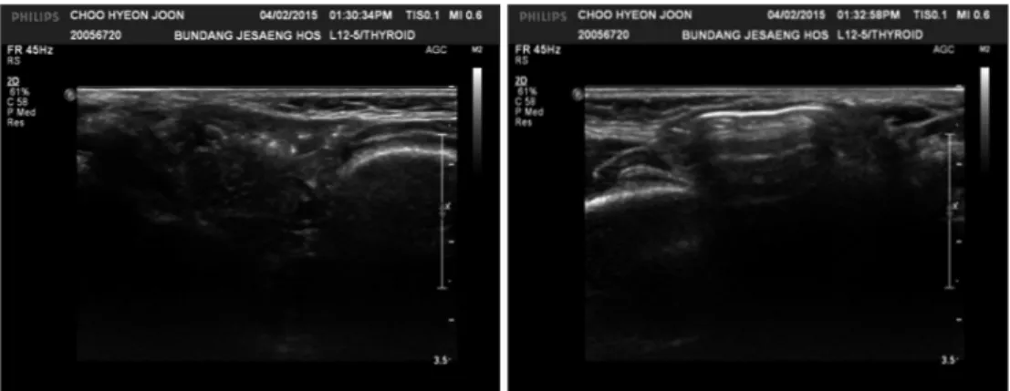 Fig. 1. US findings. Definite pathologic lesion was not observed at initial OPD visit