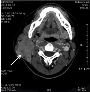 Fig. 1. A firm, fixed, oval shape mass (Black arrow).