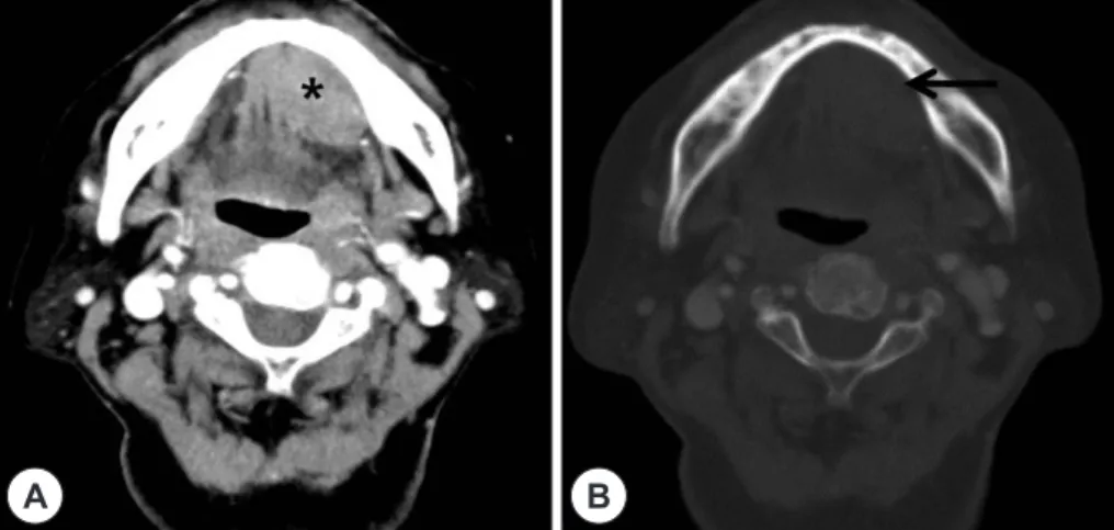 Fig. 2. Gross pathologic specimen shows white and yel- yel-low brownish cut surface (3.5×3.3 cm sized).