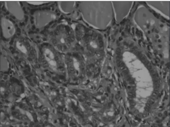 Fig. 1. Neck CT reveals 2×2 cm sized heterogeneous and  contrast enhanced mass is visible on right thyroid lobe.