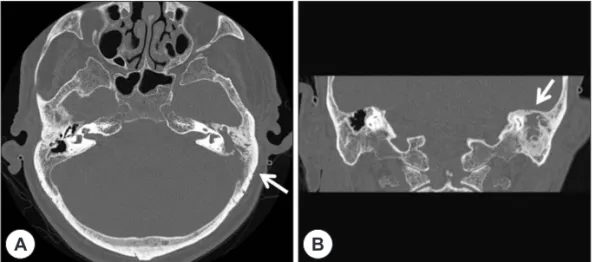 Fig. 4. Temporal bone CT demonstrates bony destruction of left lateral bony wall of sigmoid sinus on the axial view (A)  and undamaged tegmen tympani on the coronal view (B).
