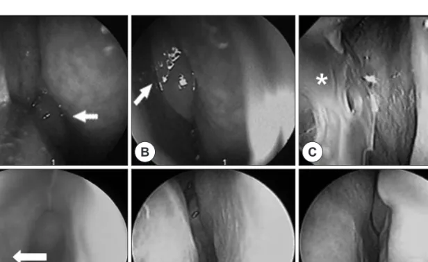 Fig. 1. Endoscopic findings. Preoperative endoscopic views of the right (A) and left (B) show polyps (white arrow) in  both nasal cavities