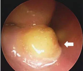 Fig. 1. Preoperative endoscopic photograph shows a  yellow-whitish mass (arrow) with surrounding granulation  tissue on the right nasal floor.