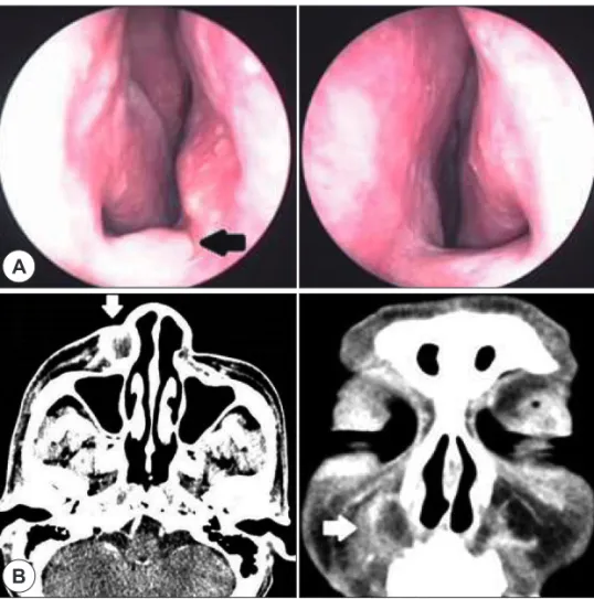 Fig. 3. Intraoperative photograph shows 13 th  canine bone 
