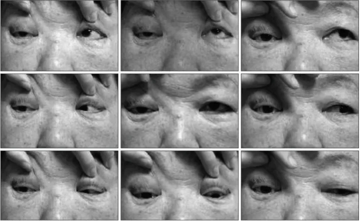 Fig. 1. Preoperative finding. Right ptosis was observed and right eye movement was decresed.