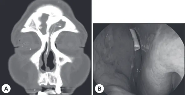 Fig. 3. A : Postoperative 2-year coronal CT shows a pediatric biliary T-tube located upward from the frontal recess
