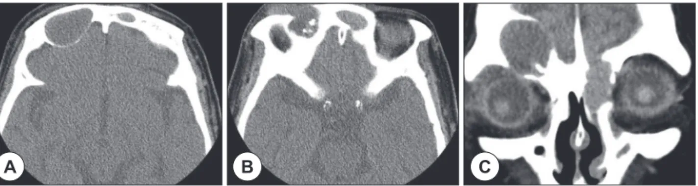 Fig. 6. CT scan shows the right frontal sinus soft tissue with calcification inside and a left frontoethmoid soft tissue  suspicious of mucocele