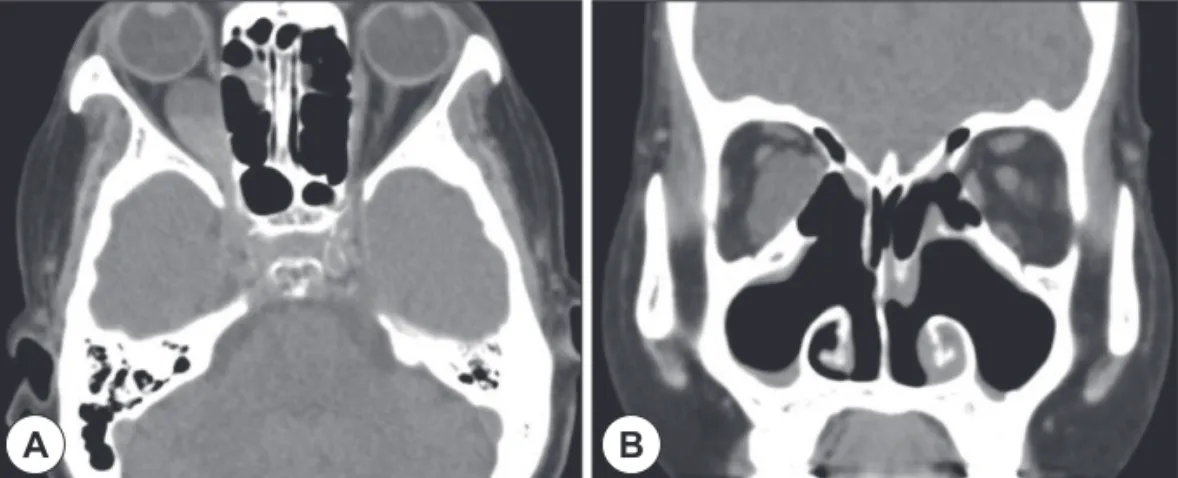 Fig. 1. Preoperative orbit computed tomography shows abnormal fluid density in the right retrobulbar area