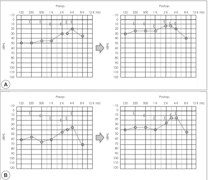 Fig. 3. Preoperative and postoperative PTA changes (at 12 months after surgery). The hearing results in our study show- show-ed a significant improvement of pre-and postoperative air-bone gap