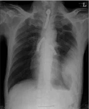 Fig. 2. Laryngoscopic finding shows both vocal cords fix- fix-ation and glottic web.