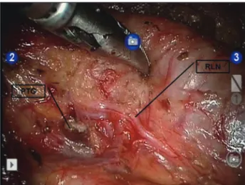 Fig. 15. Surgical field after ipsilateral thyroidectomy with  central compartment neck dissection