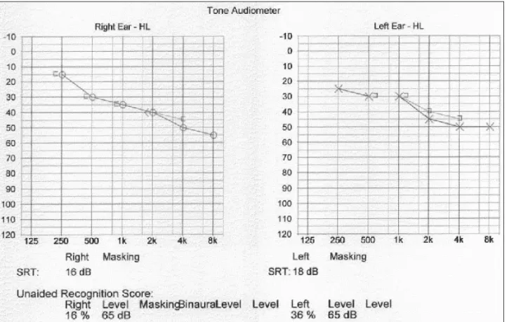 Fig. 1. The result of initial pure tone audiogram and speech audiogram shows bilateral sensory neural hearing loss