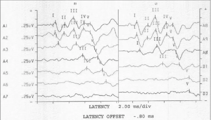 Fig. 2. Auditory brain stem evoked response represent abnormal  ave V threshold.