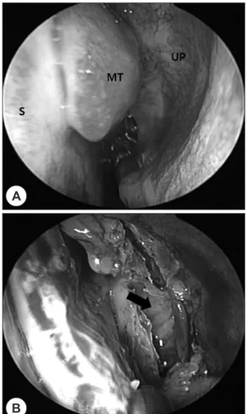 Fig. 1. Preoperative CT findings. Coronal view (A) and ax- ax-ial view (B) present both side of chronic pansinusitis with  polyposis