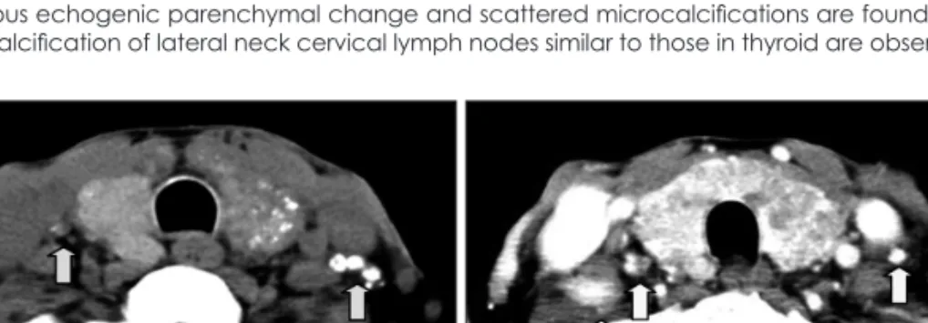 Fig. 2. Contrast non-enhanced view (A) and enhanced view (B) of neck CT findings (case 1)