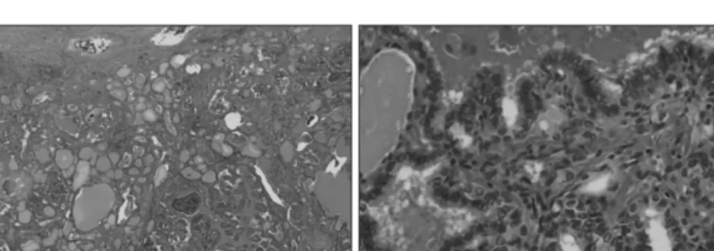 Fig. 4. Histopathologic findings (case 1). Papillary patterns covers the field diffusely, and the fibrosis and sclerosis are seen  around