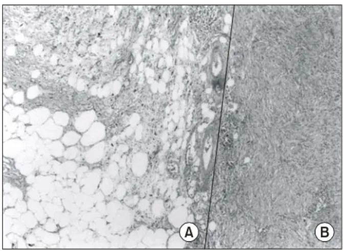 Fig.  3.  The  groups  of  scattered  lipoblasts  with  ramifying  capillary  networks  and  atypical  lipocytes