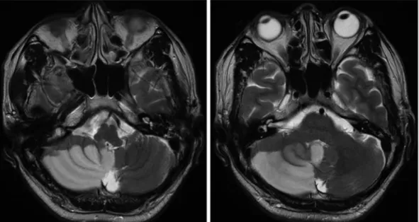 Fig. 1. T2-weighted non-enhanced axial images presented acute infarction at right PICA territory with mild diffuse brain  atrophy.