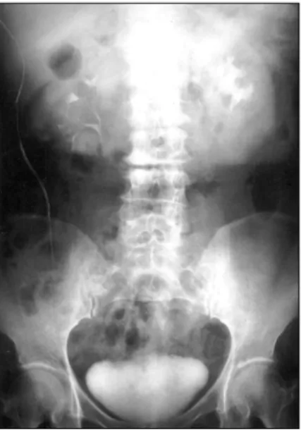 Fig.  1.  Intravenous  pyelogram  showed  delayed  excretion  of  the  left  kidney.