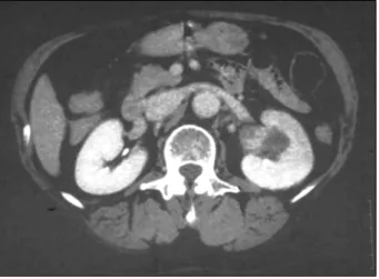 Fig.  2.  Abdominal  CT  showed  well-defined  hypodense  mass  in  the  left  kidney.