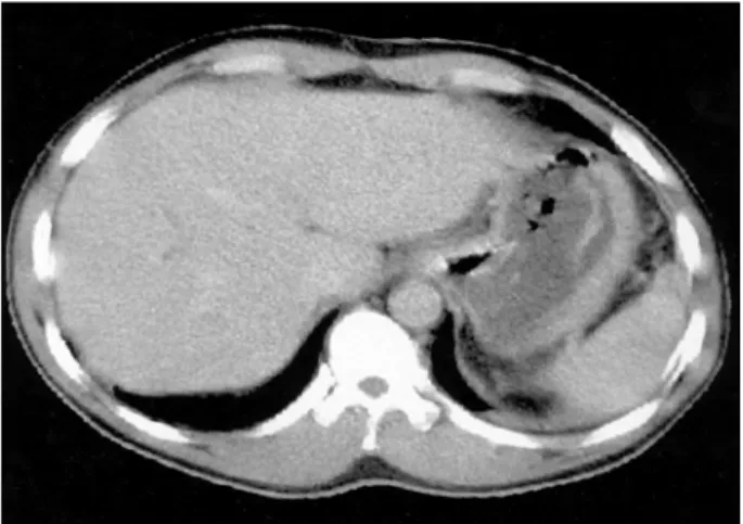 Fig.  1.  Initial  abdomen-pelvis  computed  tomographic  scan  showed  spleen  and  liver  contusion  without  evidence  of   intraperito-neal  fluid  collection.