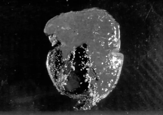 Fig.  3.  On  serial  section  of  the  operative  specimen  showed  a  huge  splenic  artery  aneurysm  measuring  6.0×2.0  cm.