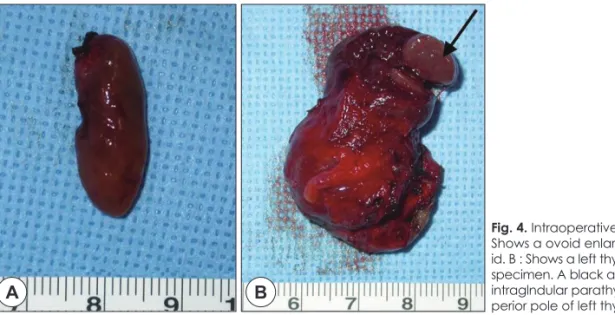 Fig. 4. Intraoperative specimens. A :  Shows a ovoid enlarged  parathyro-id. B : Shows a left thyroid lobectomy  specimen