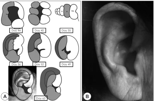 Table 1. Tanzer’s classification of auricular anomaly 2) I. Anotia