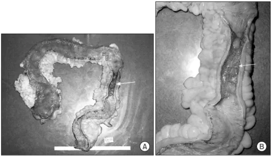 Fig.  3.  Colonoscopic  finding  shows  a  luminal  narrowing  and  mucosal  erythema  of  the  sigmoid  colon.