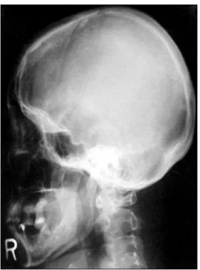 Fig.  7.  Skull  series  shows  no  mottling.