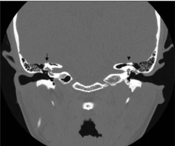 Fig. 1. Coronal computed tomography of the left tem- tem-poral bone shows bony defect of the superior  semicircu-lar canal (arrow).
