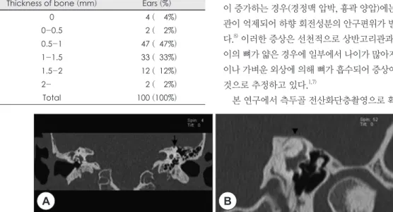 Table 2. Site of dehiscence of the superior canal between  the bony superior canal and the upper surface of the  tem-poral bone (middle cranial fossa) or through of the  supe-rior petrosal sinus