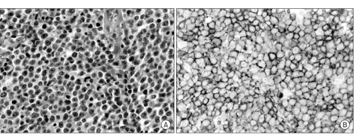 Fig.  5.  Peripheral  T  cell  lymphoma.  (A)  The  Tumor  is  composed  of  small  to  medium  sized  atypical  lymphoid  cells  (×400,  H&amp;E)