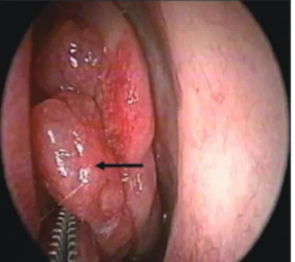 Fig. 2. Paranasal sinus computed tomography scans (A : Axial and B : Coronal view) revealed a soft tissue density mass  (arrow) between nasal septum and left middle turbinate without destructive bone change.