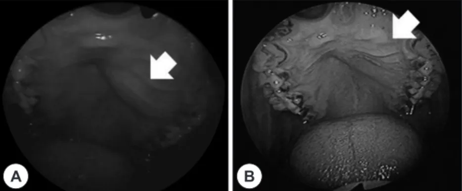 Fig. 1. A : Endoscopic  view of oral cavity showing swelling of left side of hard palate, preoperatively (white head)