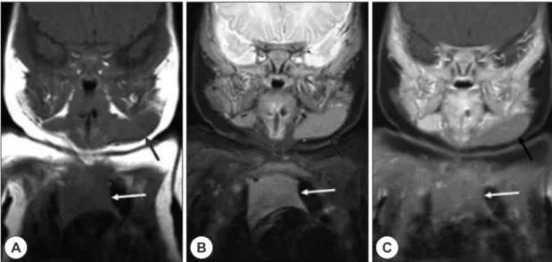 Fig. 2. The transverse US scans of left submandibular re- re-gion and thymus show homogeneous echogenic mass  with branching linear echogenic septa