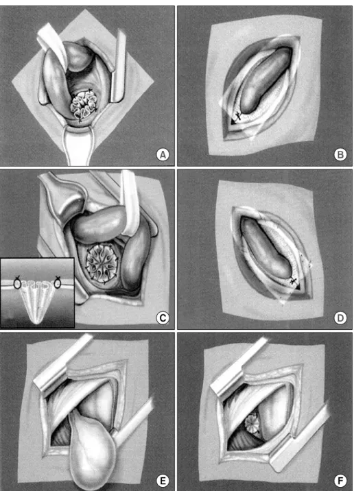 Fig.  2.  Herniorraphy  with  a  mesh  plug  and  patch  for  the  indirect  hernia  (A,  B),  direct  hernia  (C,  D)  and  femoral  hernia  (E,  F).